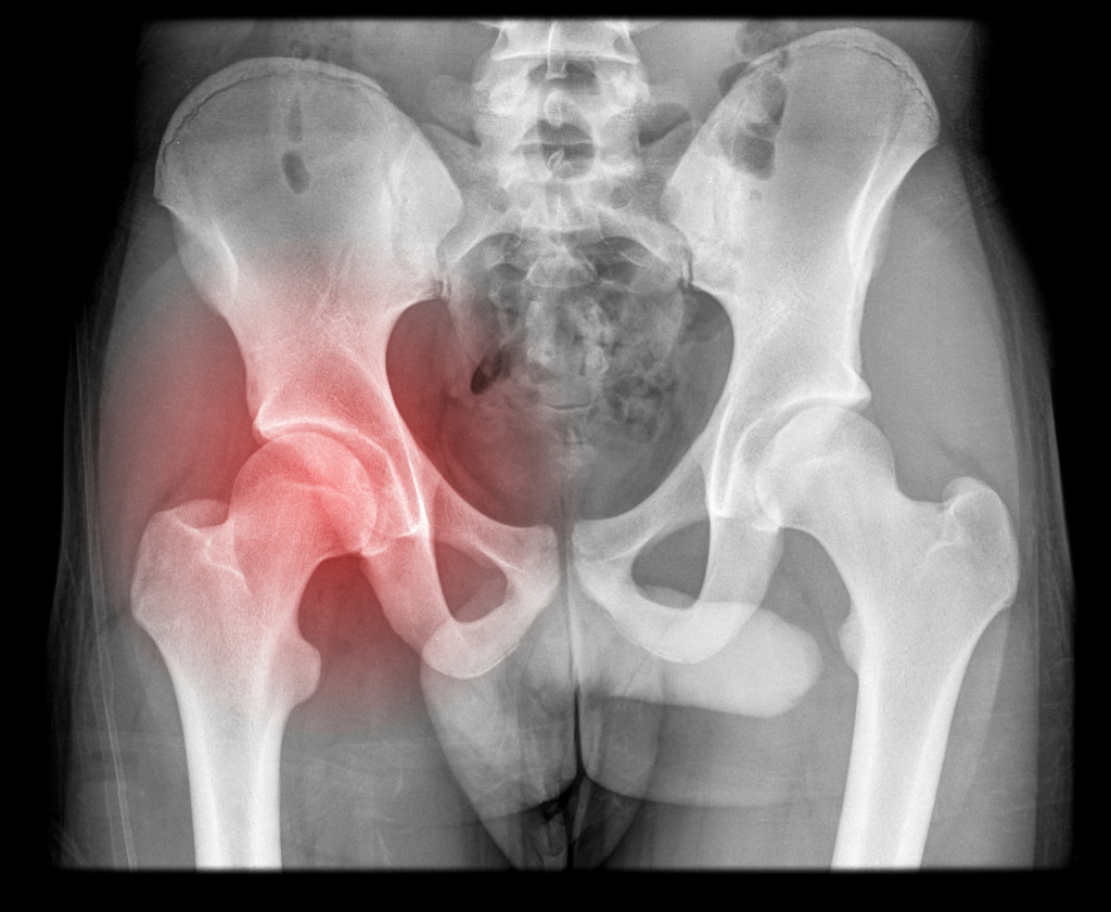 intrinsic hip and pelvic pain isolated on black background